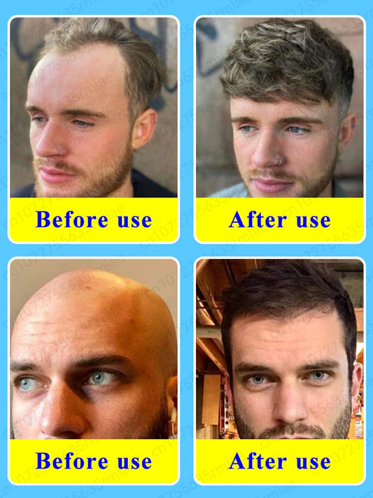 Experts have certified the most effective hair growth product, say goodbye to baldness in 7 days. Also effective for beard, ches